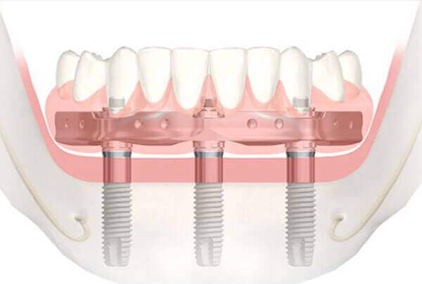 Trefoil Lower Arch Prosthesis Rockland Ontario